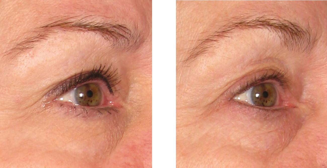 ultherapy brow lift before after result
