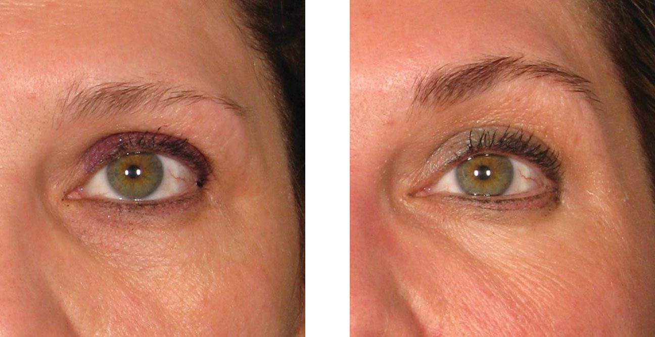 ultherapy brow lift before after