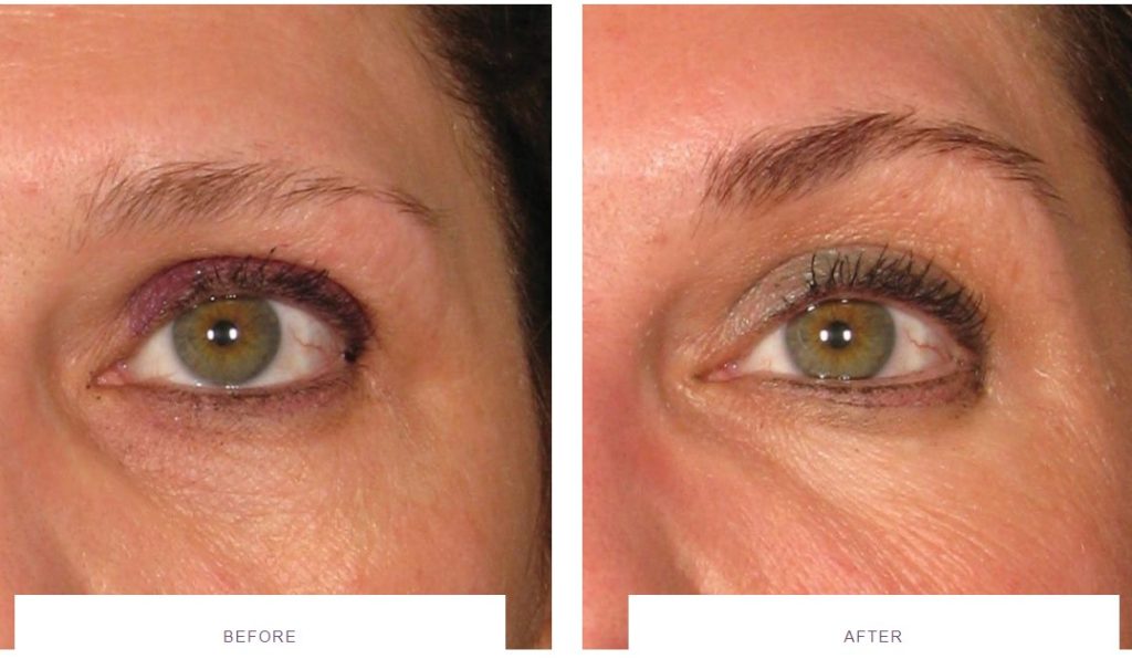ultherapy brow lift before and after