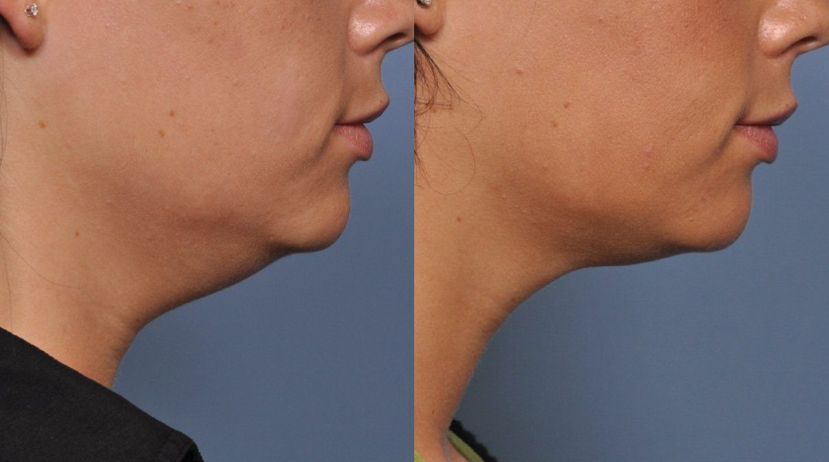 ultherapy double chin before and after