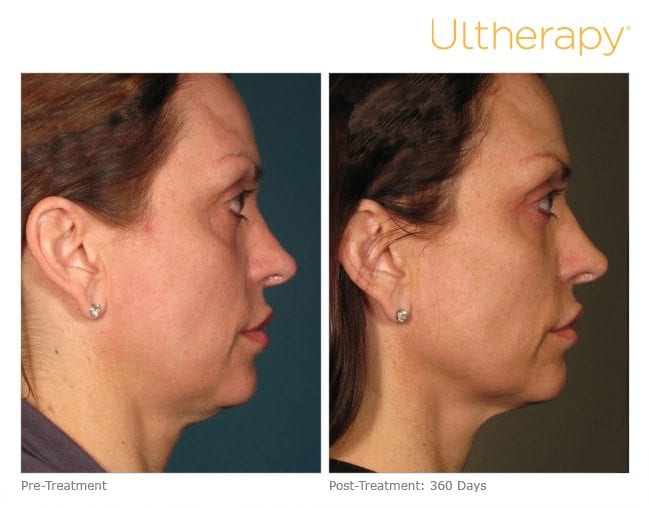 Ultherapy Facelift Before and After