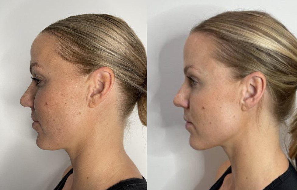 ultherapy for jawline - jaw contouring before and after