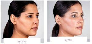 ultherapy full face side before after