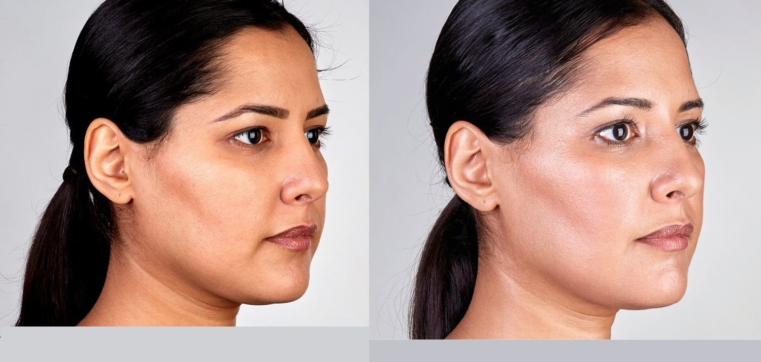 ultherapy jawline facelift before and after