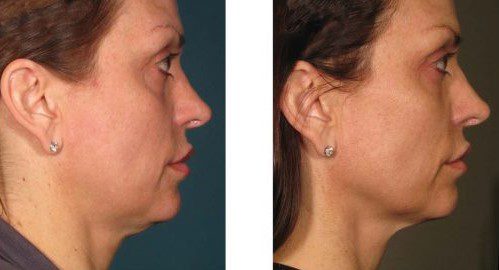 ultherapy jawline skin tightening before and after