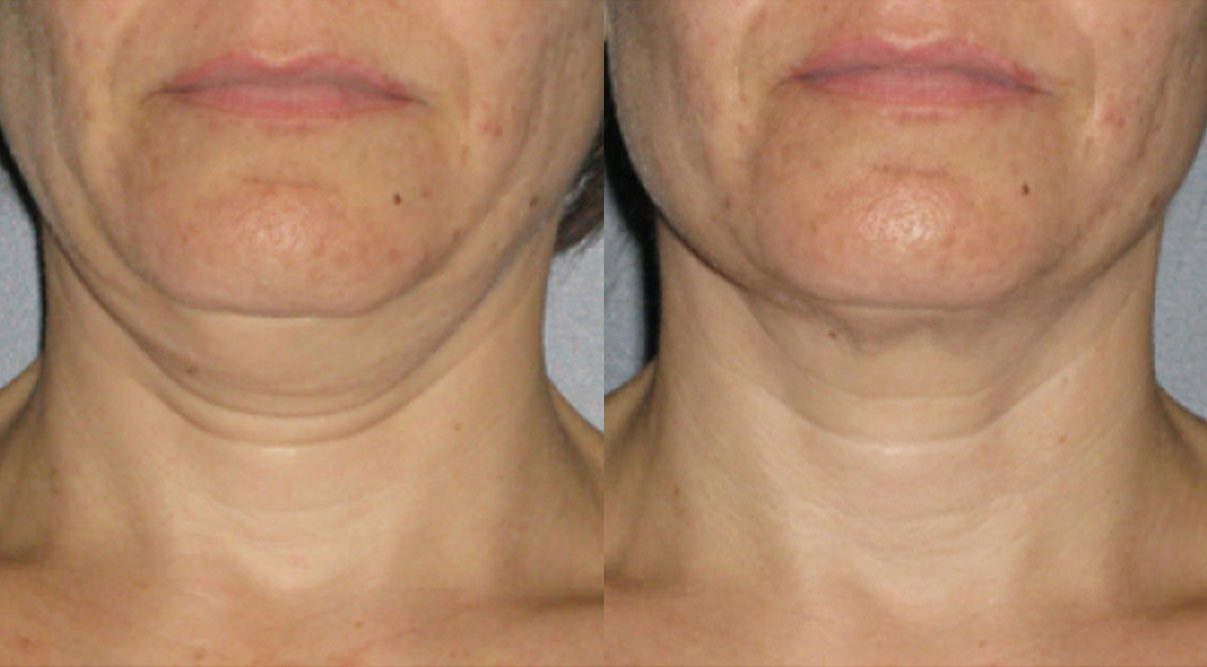 ultherapy neck lift before and after