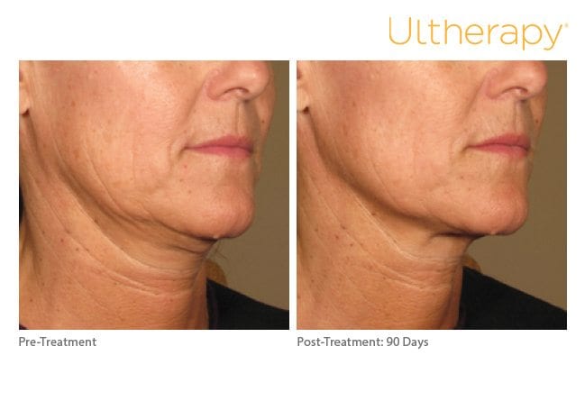 Ultherapy neck lift before after