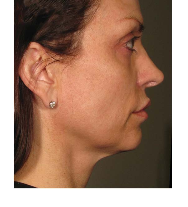Ultherapy Skin Tightening After Photo