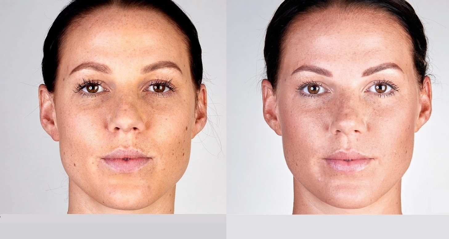 ultherapy non surgical face lift face contouring before and after