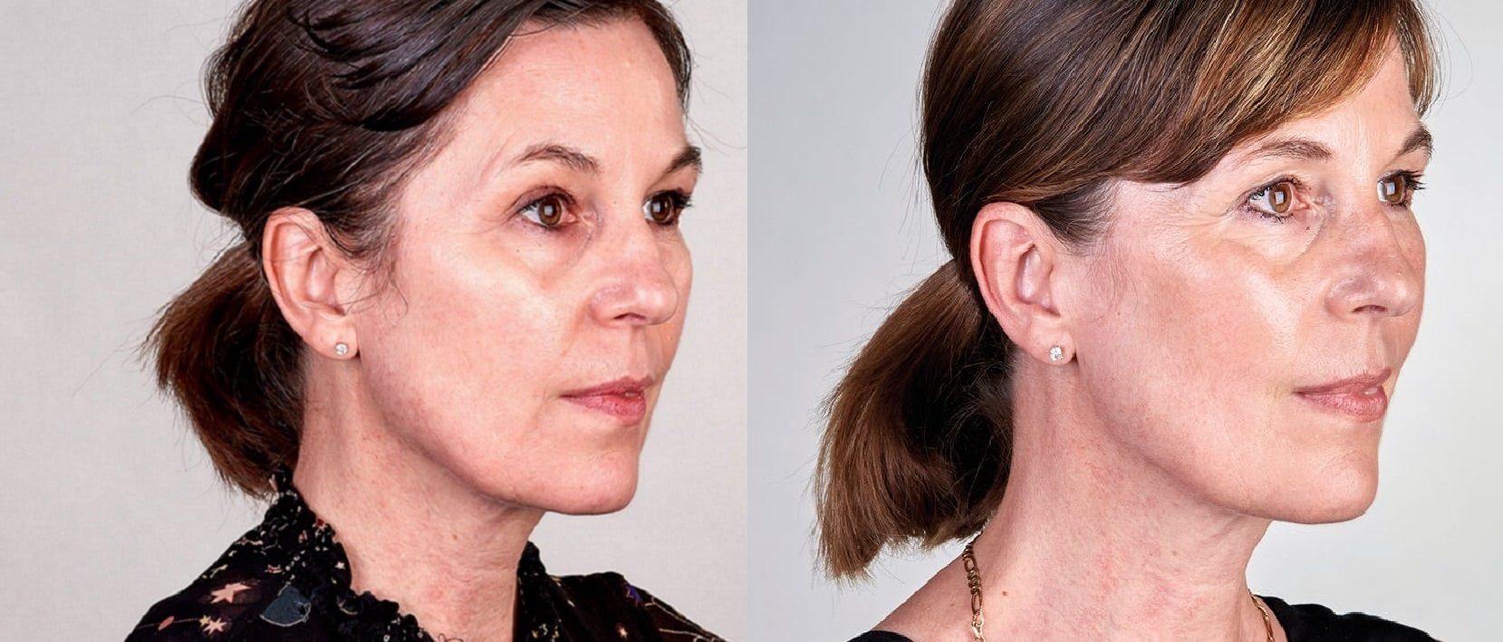ultherapy non surgical face lift neck lift before and after