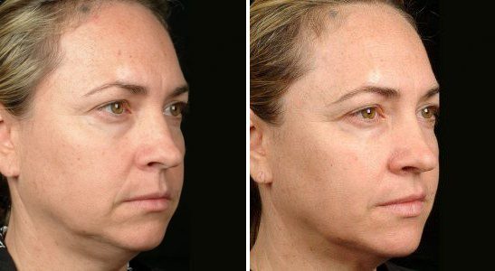 ultherapy non surgical facelift before and after
