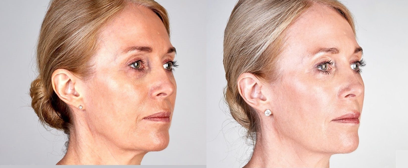 ultherapy non surgical facelift neck lift before and after