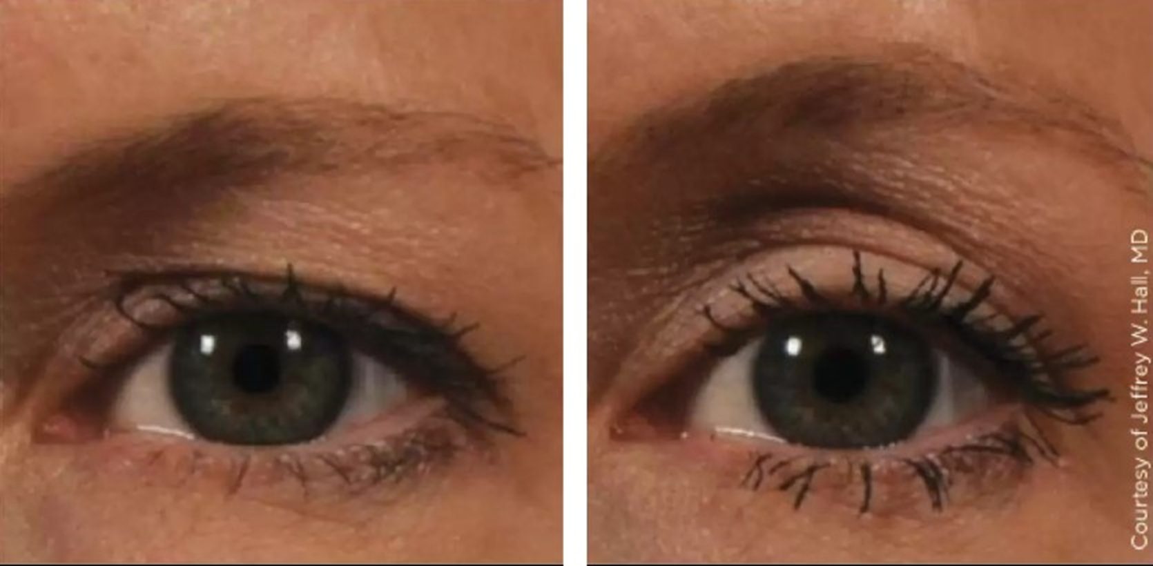 ultherapy prime eyebrow lift before and after results