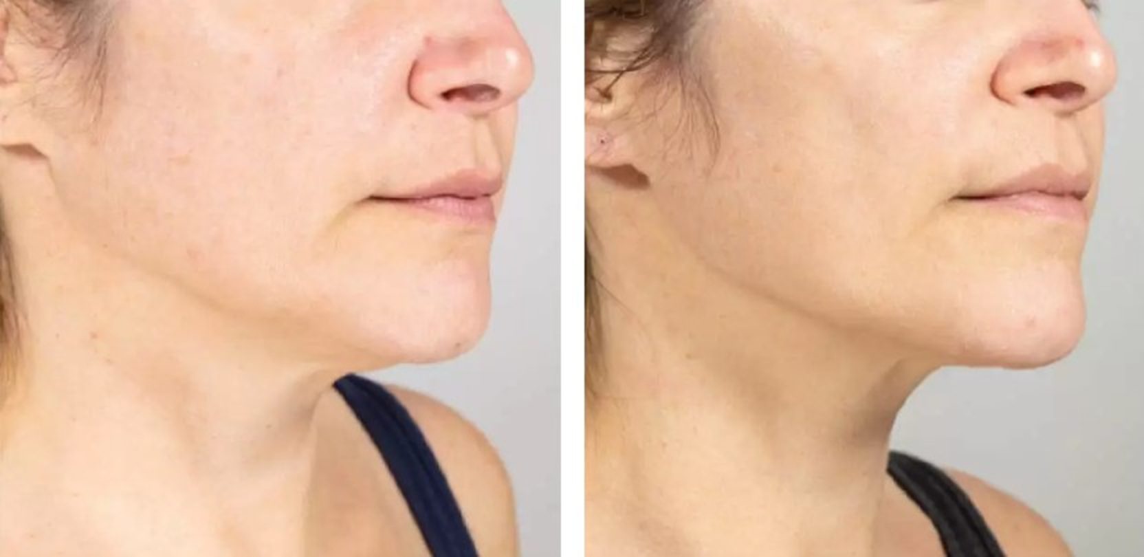 ultherapy prime jawline lift before and after results