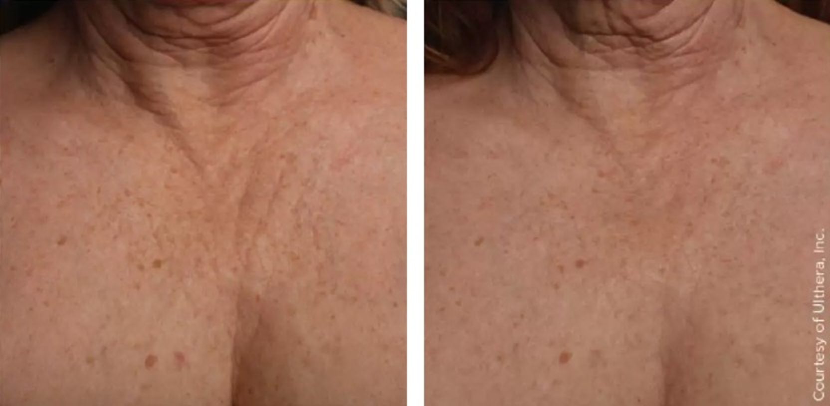 ultherapy prime wrinkly chest before and after results