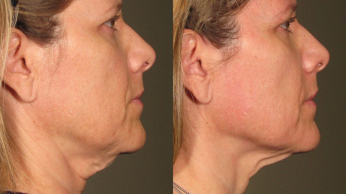ultherapy saggy neck skin tightening before and after