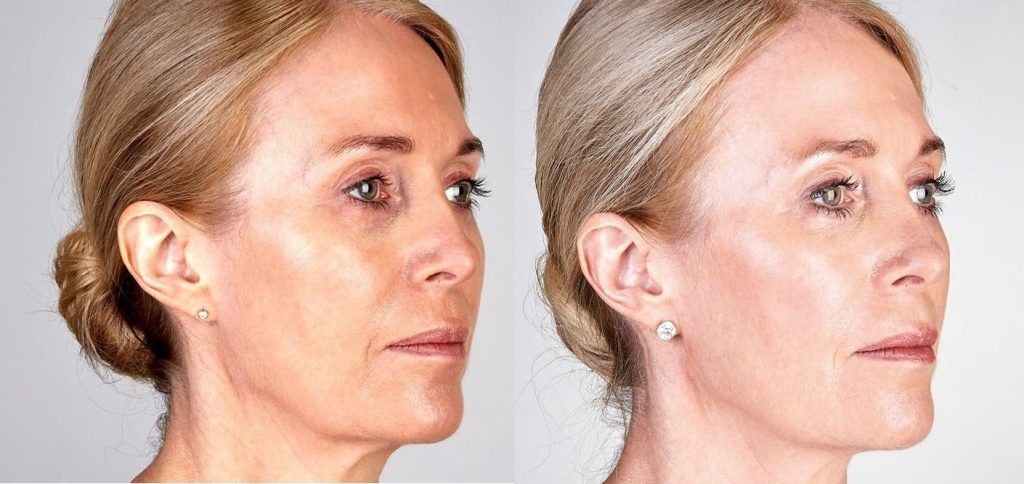 ultherapy skin tightening before and after