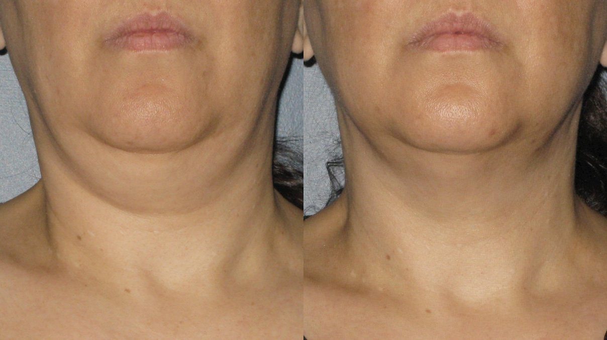 ultherapy skin tightening for double chin before and after