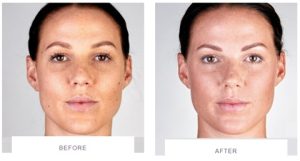 ultherapy skin tightening full face front before after