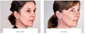 ultherapy skin tightening full face side before after