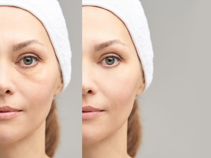 Thermage V Ultherapy Results