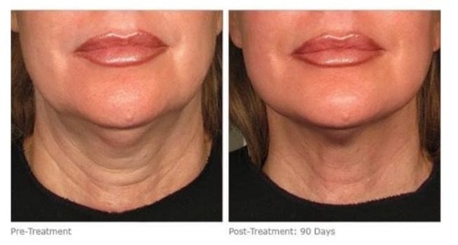 Ultherapy Lip Filler Treatment