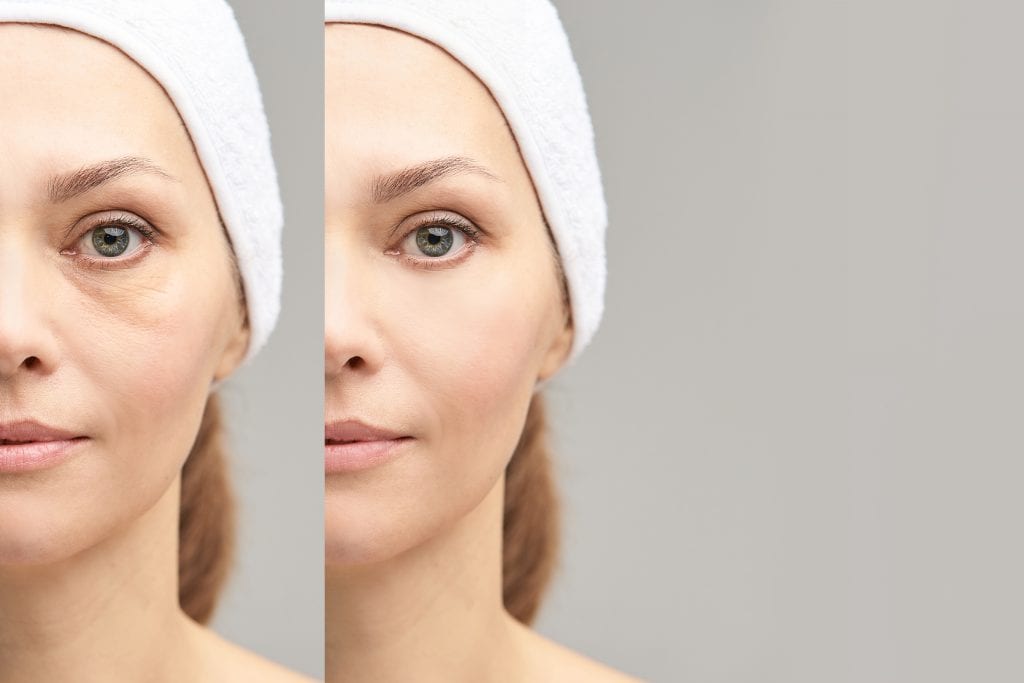 Dark Circles Under The Eyes: Causes & Treatments