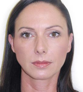 upper face botox London after