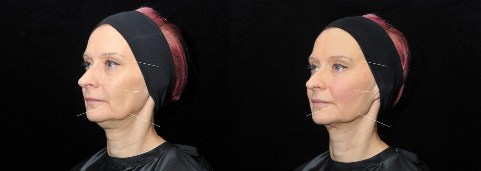 Facelift with Temple Fillers Non surgical Facelift The Cosmetic