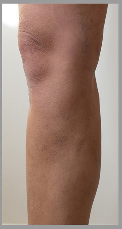 Varicose veins removal after
