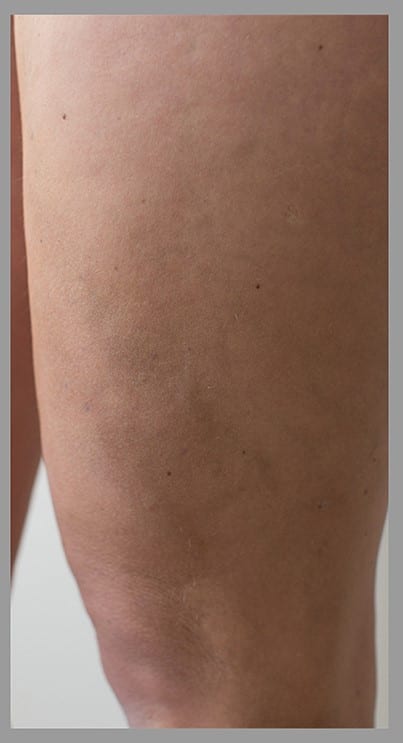 Varicose veins removal after