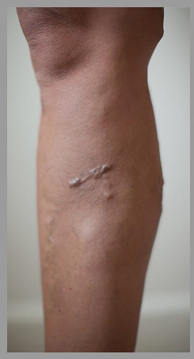 Varicose veins removal before