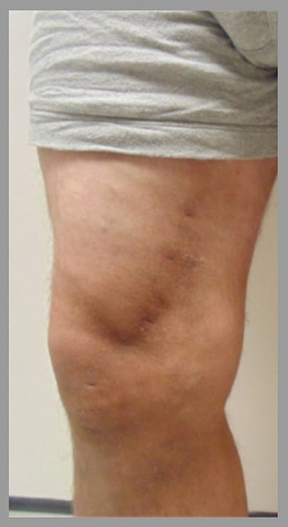 Varicose Veins Removal After