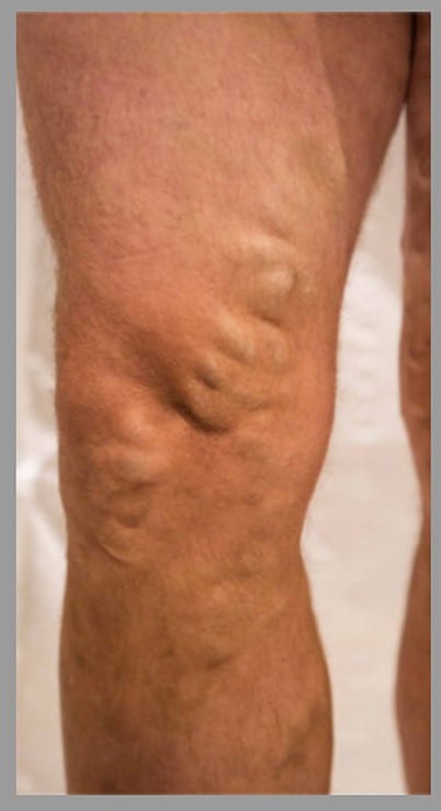 varicose vein removal before