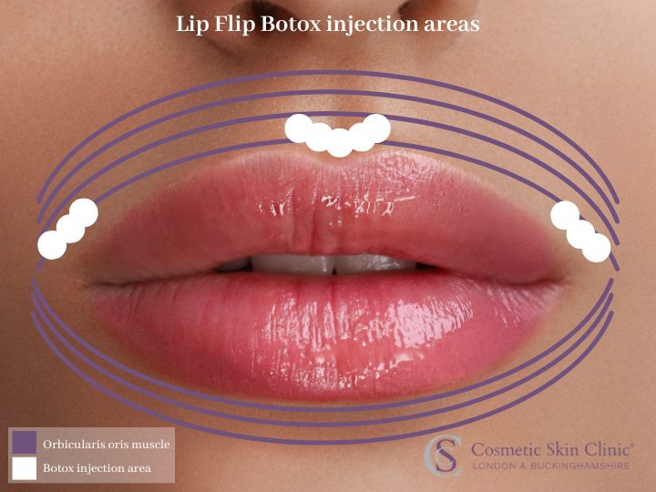 where to inject botox for lip flip